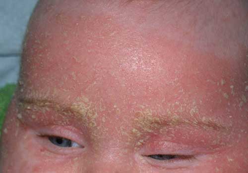 Viêm da tiết bã - Hình ảnh minh họa